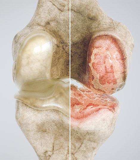 l'arthrose du genou